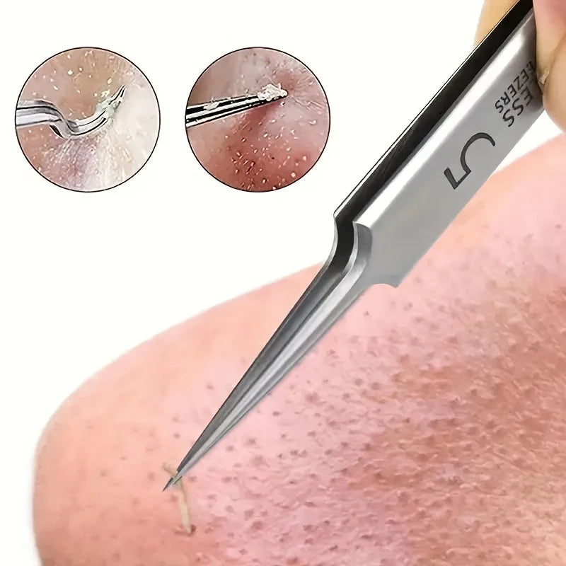 5pcs Stainless steel tweezers for powerful blackhead removal, suitable for all skin types