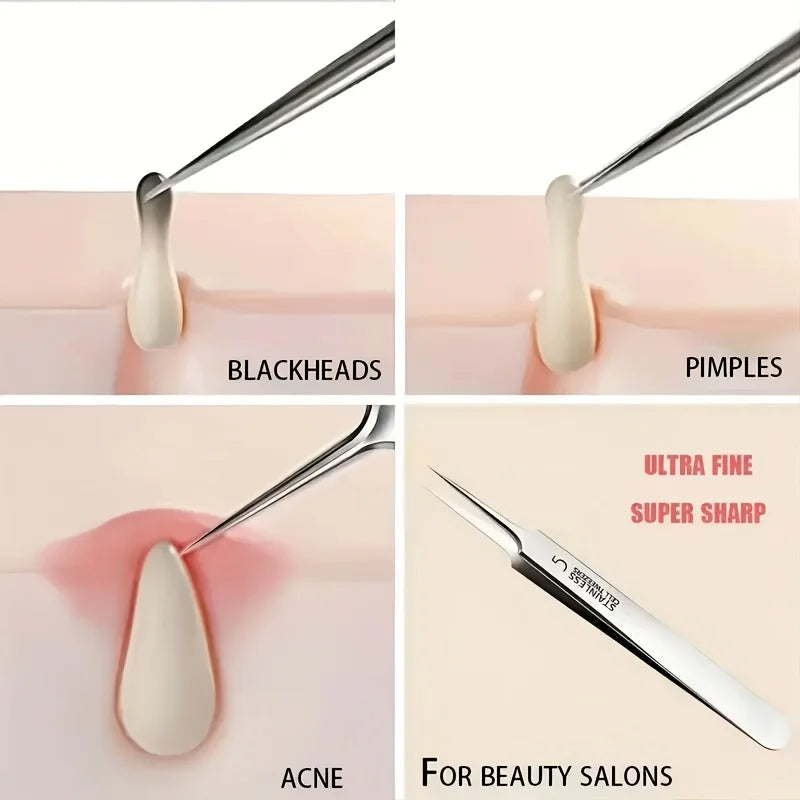 5pcs Stainless steel tweezers for powerful blackhead removal, suitable for all skin types